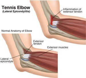 Wrist extensor stretch best sale for lateral elbow pain